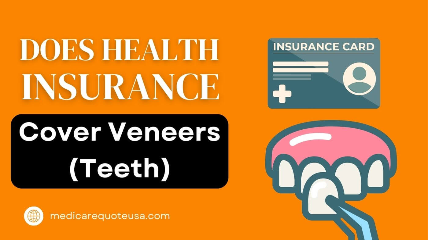 Does Health Insurance Cover Veneers (Teeth) in USA 2024