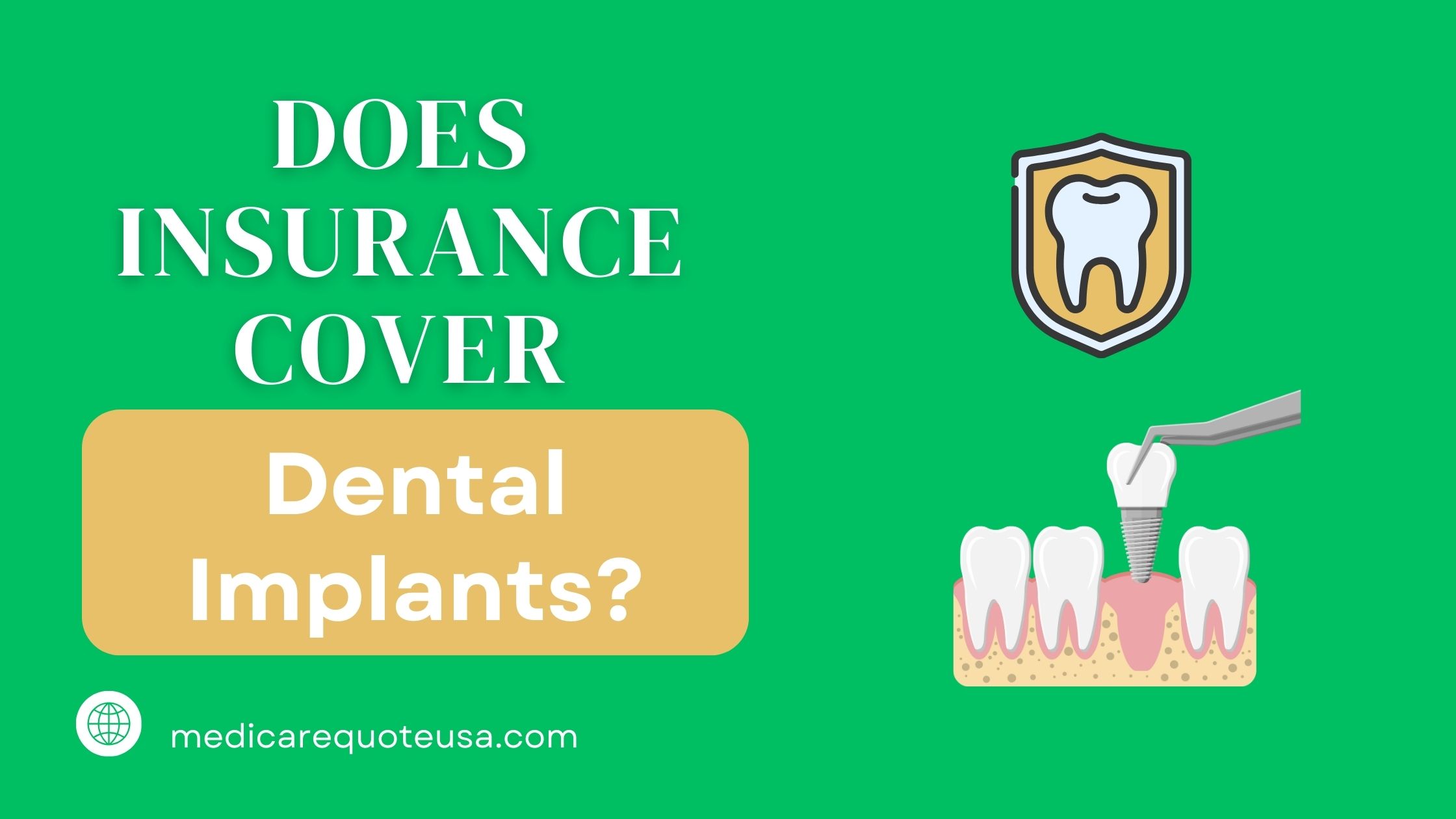 Does Insurance Cover Dental Implants In USA
